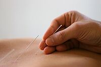 Akupunktur bei Rückenschmerzen 